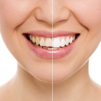 Before and after of receiving teeth whitening