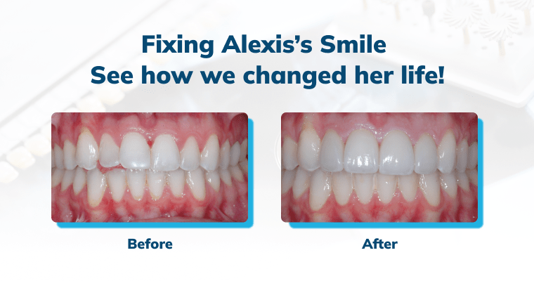 Before and after image of Alexis's renewed smile
