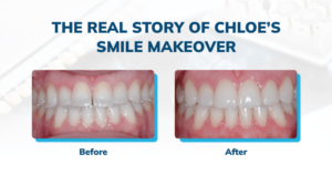 The Real Story of Chloe's Smile Makeover