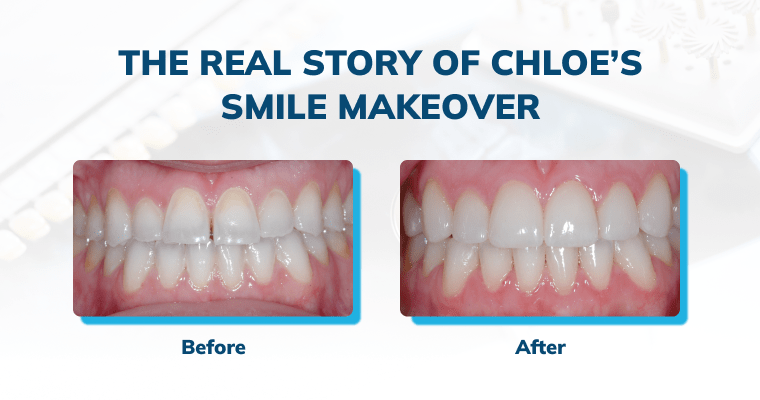 The Real Story of Chloe's Smile Makeover