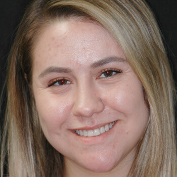Chloe who is a patient at Benjamin Turnwald Dentistry who underwent cosmetic dentistry in Schaumburg, IL. View her before and after Smile Gallery photo.